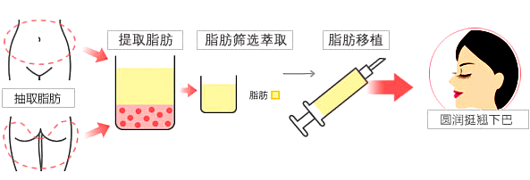 自体脂肪,丰下巴,过程,长春好的整形医院