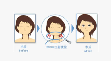 注射,BOTOX,瘦脸,长春好的整形医院