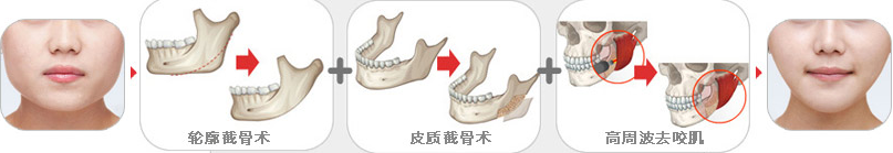 瘦脸,磨骨,对比图,长春好的整形医院