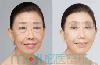 激光,除皱,对比图,长春好的整形医院