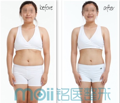 水动力,吸脂,对比图,长春好的整形医院