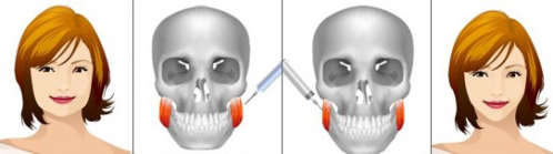 大脸,瘦脸针,长春好的整形医院