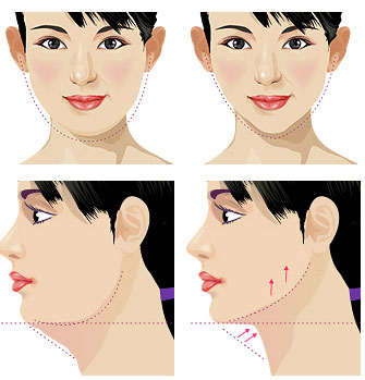 大脸,瘦脸针,长春好的整形医院