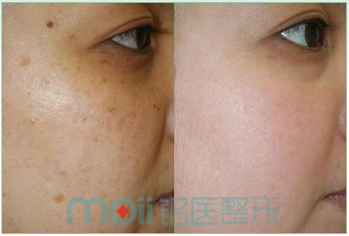 激光祛斑,对比图,长春好的整形医院