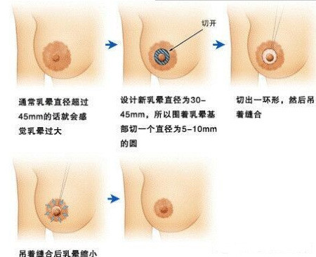 精致胸部,标准,外观,长春好的整形医院