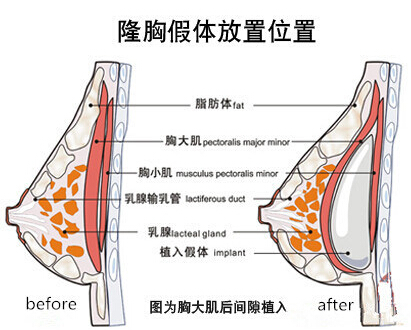 隆胸,哺乳,乳腺,乳腺导管,长春好的整形医院
