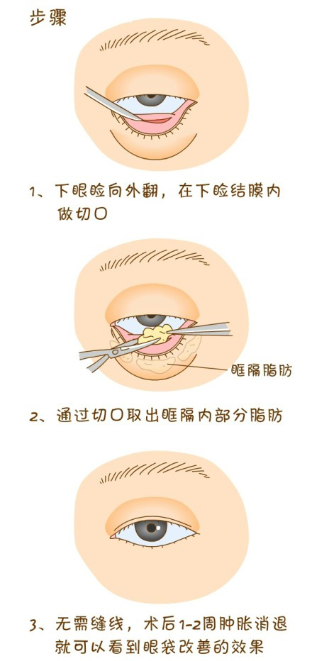 眼袋,内切法,过程,长春好的整形医院