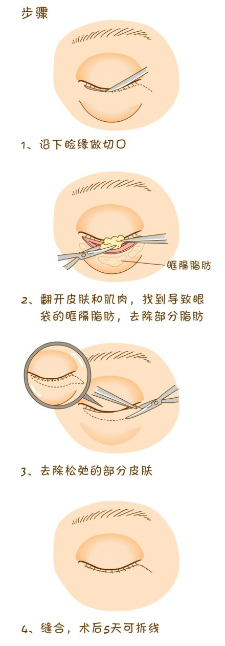 眼袋,外切法,过程,长春好的整形医院
