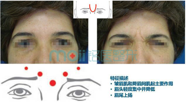 皱眉纹类型,U型,长春好的整形医院