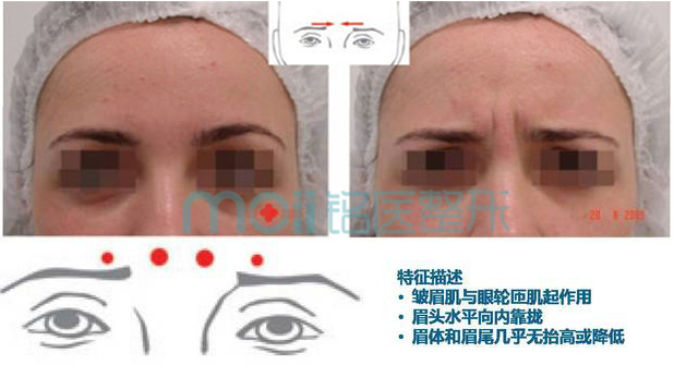 皱眉纹类型,向内集中型,长春好的整形医院