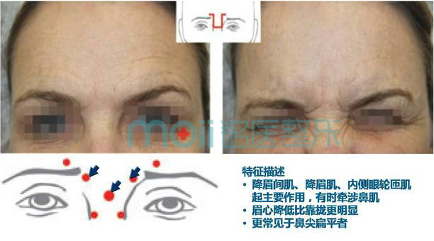 皱眉纹类型,倒Ω型,长春好的整形医院