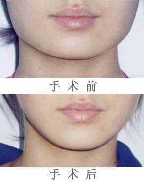 咬肌肥大缩小,对比图,长春好的整形医院