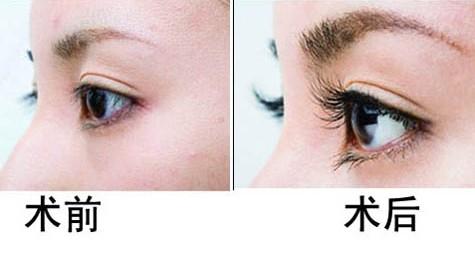 睫毛种植术,对比图,长春好的整形医院