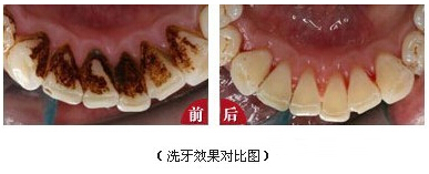 洗牙,对比图,长春好的整形医院