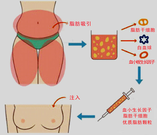 自体脂肪,丰胸,长春好的整形医院