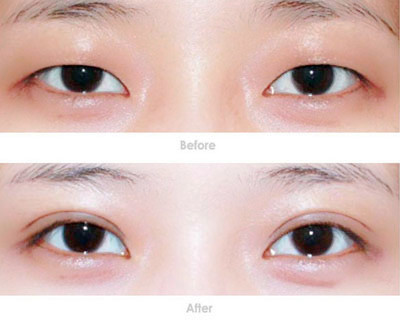 埋线双眼皮,对比图,长春好的整形医院
