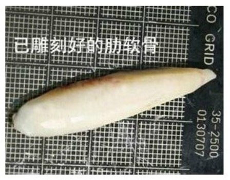 自体,肋软骨,隆鼻,过程,长春好的整形医院