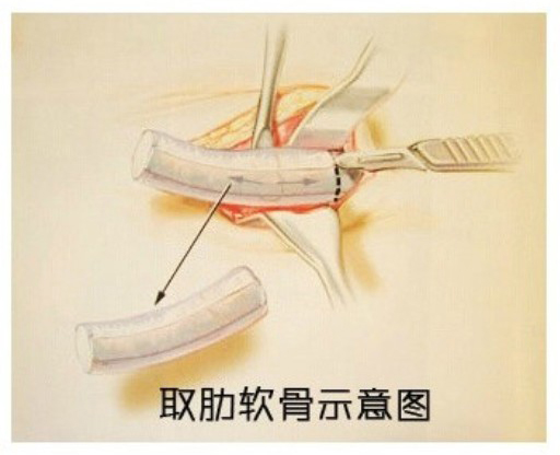 自体,肋软骨,隆鼻,过程,长春好的整形医院