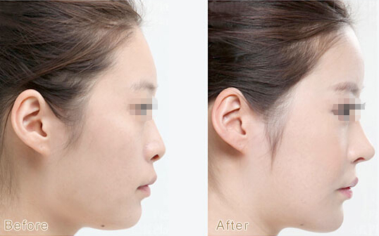 肋软骨隆鼻,对比图,长春好的整形医院