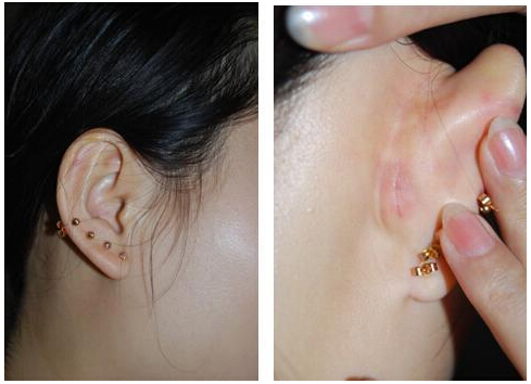 自体软骨,隆鼻,耳软骨,长春好的整形医院