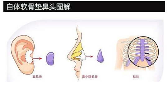 鼻体软骨,鼻头,图解,长春好的整形医院