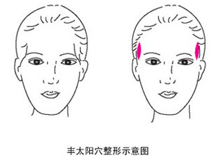 丰太阳穴,对比图,示意图,长春好的整形医院
