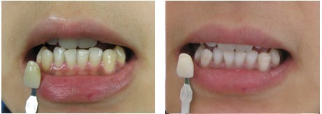 超声波,洁牙,对比图,长春好的整形医院