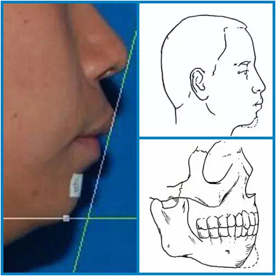 下巴突度,示意图,长春好的整形医院