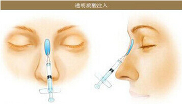 玻尿酸,隆鼻,长春好的整形医院