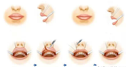 厚唇变薄,过程,长春好的整形医院