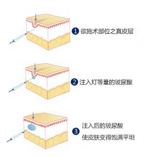 玻尿酸丰唇,原理,长春好的整形医院