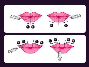 玻尿酸丰唇,过程,长春好的整形医院