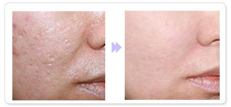 祛痘印,除痘印,对比图,长春好的整形医院