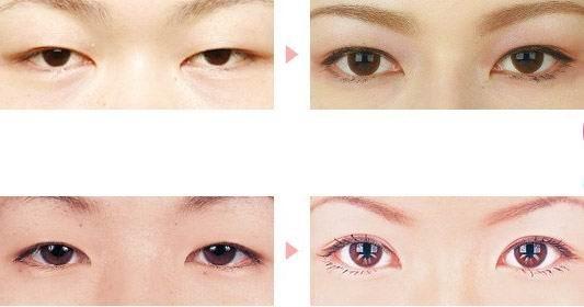 开眼角,双眼皮,对比图,长春好的整形医院