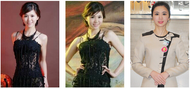 颜世楠,自体脂肪丰额头,对比图,长春好的整形医院