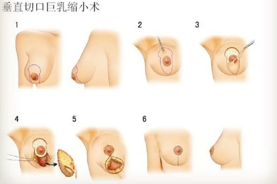 巨乳缩小手术,过程,长春好的整形医院