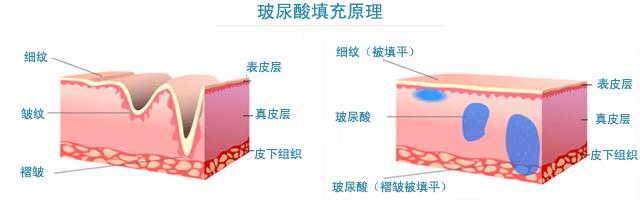 玻尿酸,除皱,原理,长春好的整形医院