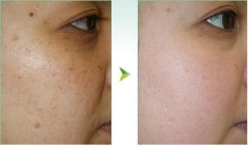 光子嫩肤,色斑,红血丝