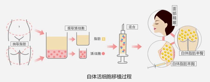 颜世楠,自体脂肪丰额头,长春好的整形医院