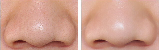 去黑头,对比图,长春好的整形医院