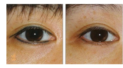 激光洗眼线,对比图,长春好的整形医院