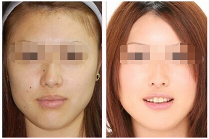 激光祛痣,对比图,长春好的整形医院