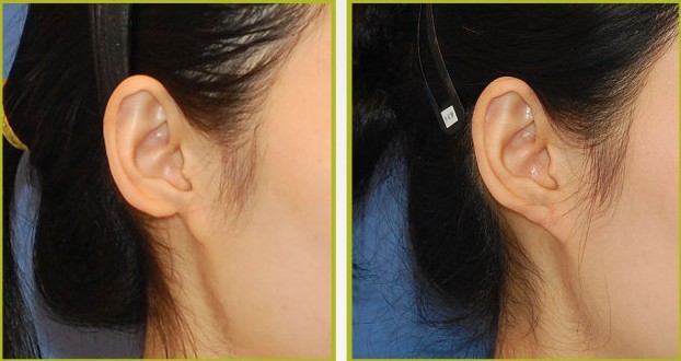 玻尿酸,丰耳垂,对比图,长春好的整形医院