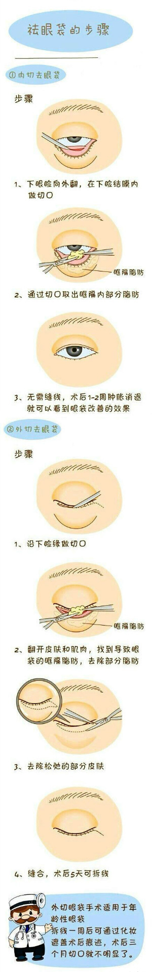 祛眼袋手术,内切法,外切法,长春好的整形医院