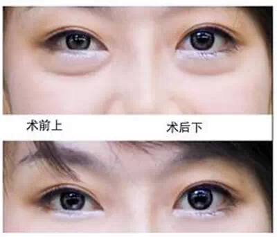 祛眼袋,对比图,长春好的整形医院