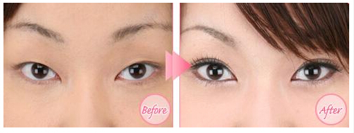 双眼皮,对比图,长春好的整形医院