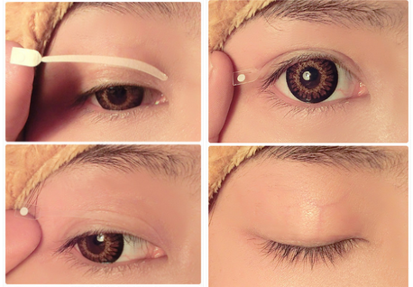 双眼皮,全过程,图解,长春好的整形医院