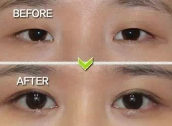 双眼皮,对比图,长春好的整形医院