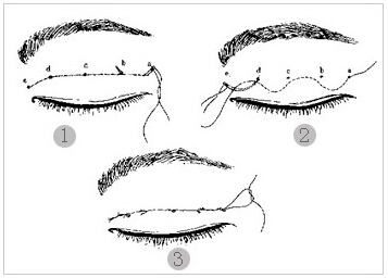 双眼皮,过程,长春好的整形医院