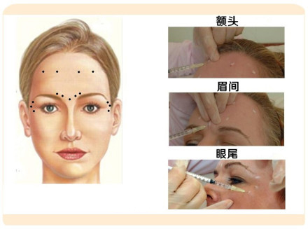 肉毒素,除皱,多汗,长春好的整形医院